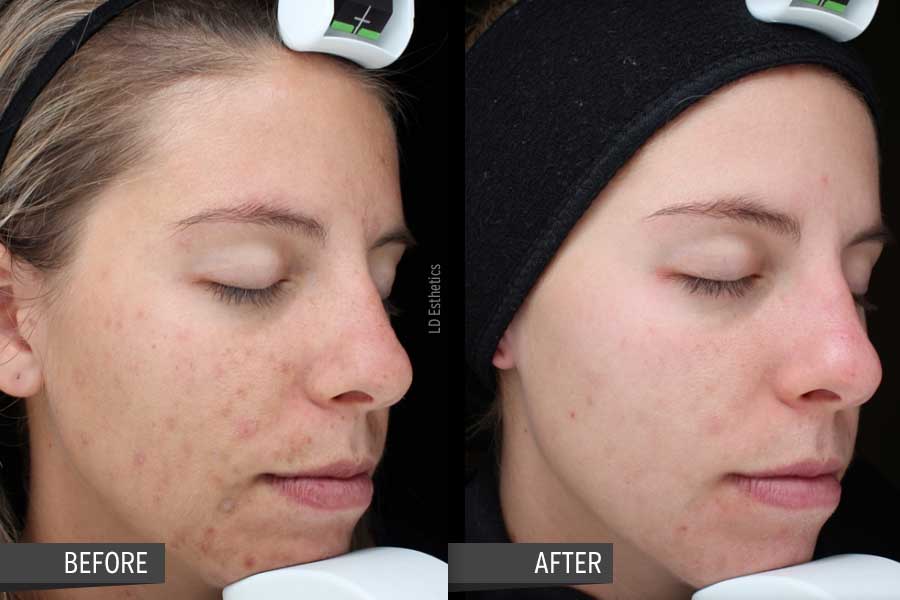 Acne, Acne Marks, Pigment and Anti-Aging