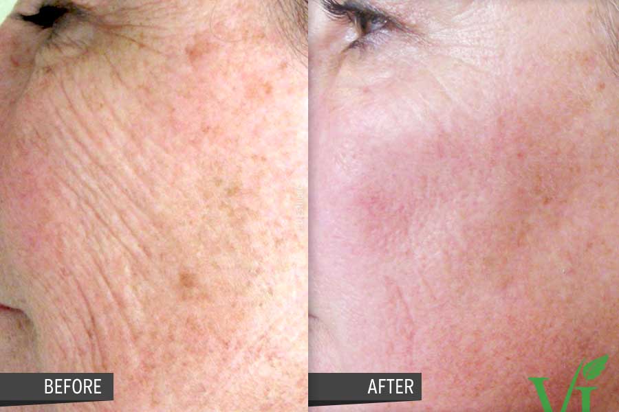Fine Lines, Wrinkles, Tone & Texture and Aging Skin